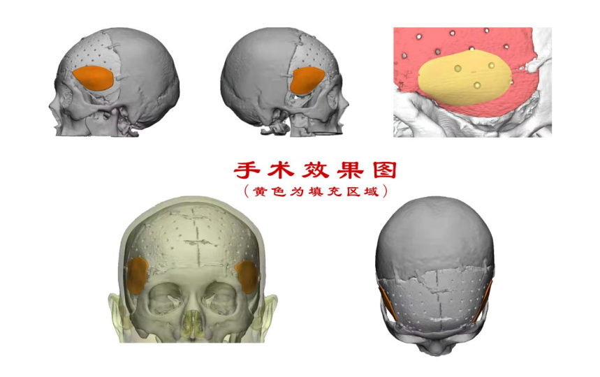 林志穎車禍致顏面骨折，醫生：或可用3D打印建模進行術后修復