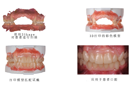 3Shape彩色工作流程，讓牙齒假體越來越“真”！