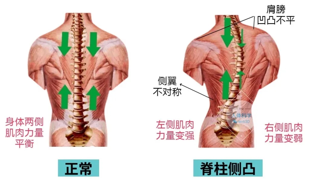 3D打印脊柱側(cè)彎矯形器：從“被動(dòng)矯正”到“精準(zhǔn)醫(yī)療”的跨越式革新  